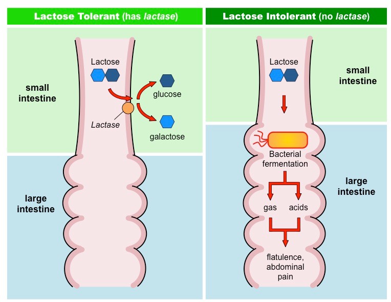 Example Of A Lactose Intolerance